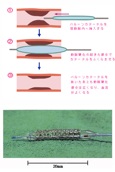 catheter